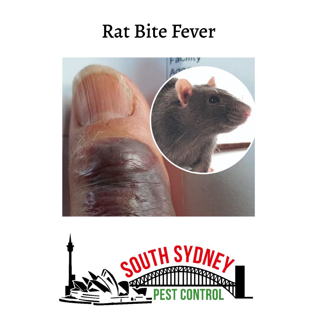 rat bite fever